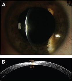 FIGURE 4. A and B: AS-OCT revealing corneal pathology thickness.