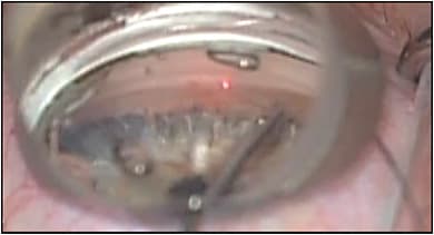 Figure 2. Insertion of the iTrack catheter (Ellex) into Schlemm’s canal.