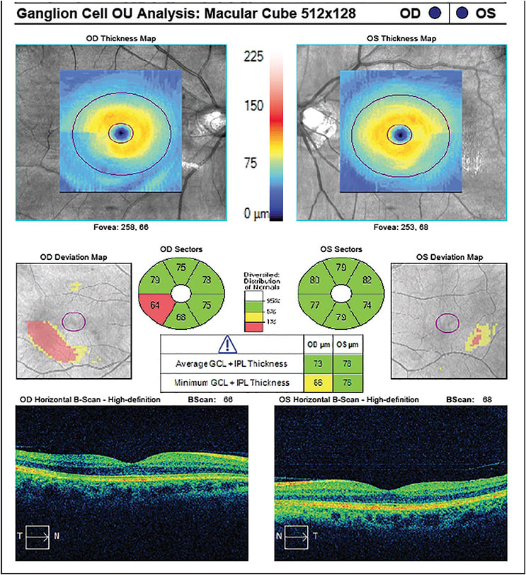 Figure 4. Ganglion cell analysis showing focal loss OD, which also corresponds to visual field defect and nerve fiber layer defect in a 59-year-old Asian male.