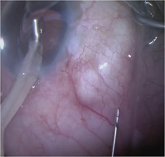 Figure 1. The “ring of steel” visible on a bleb prior to needling.
