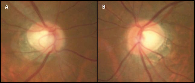 Figure 1. Cup-to-disc ratio OD (A) and OS (B) in a 59-year-old Asian male with visual field defect, mildly elevated IOP, and suspicious nerves.