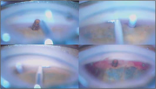 Figure 3. Cypass (Alcon) combined with 2 first-generation iStents (Glaukos).