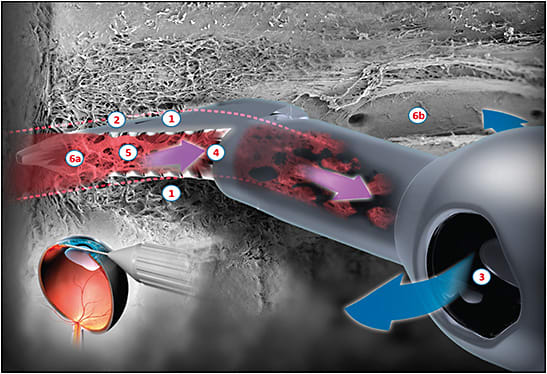 Figure 2. A rounded footplate guides the tip along Schlemm canal and guards against outer wall damages. A footplate lifts the TM on the right and left onto serrated blades that cut the TM, allowing it to be aspirated into the aspiration port. Diverging, serrated blades (A), protective footplate (2), irrigation port (3), aspiration port (4), excised trabecular meshwork (5), intact trabecular meshwork (6a), unroofed Schlemm canal (6b).