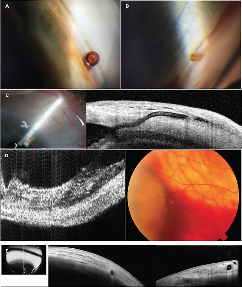 Figure 5. Cypass (Alcon) and Xen (Allergan) stents placed into the suprachoroidal and subconjunctival compartments, respectively. Cypass (A), Xen gel stent (B), postoperative changes can be correlated to structural changes seen on imaging and used to determine clinical outcomes (C), choroidal hemorrhage in CyPass (D), imaging used to gauge the function of Xen stent by evaluating structural changes over time (E).