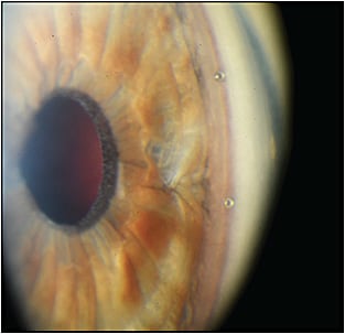 Figure 1. The iStent inject stents inserted in the trabecular meshwork.