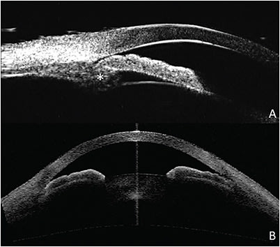 Figure 3. Ultrasound biomicroscopy (A) and optical coherence tomography (B) of the same eye with plateau iris. On ultrasound biomicroscopy, the anteriorly directed ciliary process is clearly visualized (asterisk). This is not seen with optical coherence tomography, although the flat iris plane and its steep angulation to its insertion can be appreciated. Images courtesy of Tin Aung, MBBS, FRCS(Ed), PhD