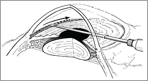 Figure 1. Goniotomy, introduced by Otto Barkan in 1936, is shown here with a pass toward the right bisecting the trabecular meshwork (goniolens not shown).