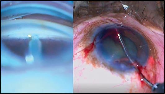 Figure 5. Trabectome combined with ab-interno canaloplasty.