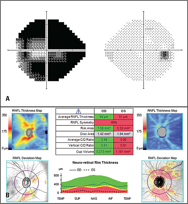 Figure 1. Humphery visual field (A) and optical coherence tomography (B) showing advanced loss in the left eye with a relatively normal right eye in a patient with juvenile open-angle glaucoma.