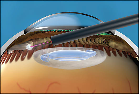 Figure 2. Illustration showing the application of laser during endoscopic cyclophotocoagulation with the laser probe inside the eye treating the ciliary processes. Note that the normal lens has been replaced by an intraocular lens.