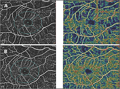 Figure 3. OCTA scan (Avanti with AngioVue; Optovue) of macular vessels before (A) and 1 month after glaucoma surgery (B).