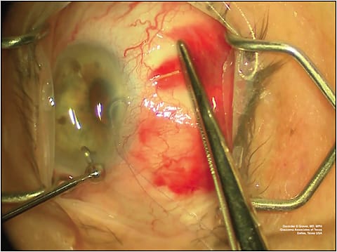 Figure 3. Intraoperative photograph demonstrating the use of conjunctival forceps to milk away the blood and chemosis and allow for optimal visualization of the Xen implant. This image is from a different case than the case shown in Figures 1, 2, and 4.