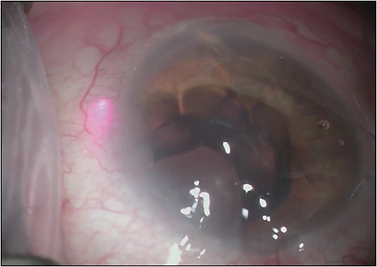 Figure 2. iTrack illuminated catheter (Ellex) seen passing though Schlemm’s canal during gonioscopy-assisted transluminal trabeculotomy in a patient with juvenile open-angle glaucoma.