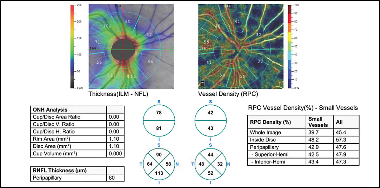 Figure 2. Angio disc quickVue (Optovue).