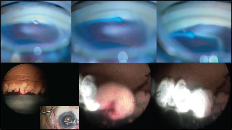 Figure 1. Trab 360 circumferential trabeculotomy combined with ECP (BVI).