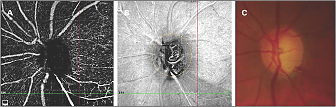 Figure 5. OCTA scan (A, B) (Avanti with AngioVue; Optovue) and optic nerve head photograph (C) showing optic nerve head hemorrhage and corresponding decrease in vessel density.