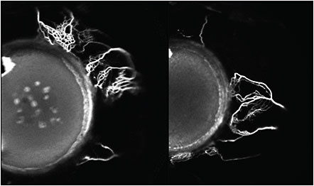 Figure 1. Optical coherence tomography imaging of aqueous humor outflow.IMAGES COURTESY OF ALEX S. HUANG, MD, PHD.