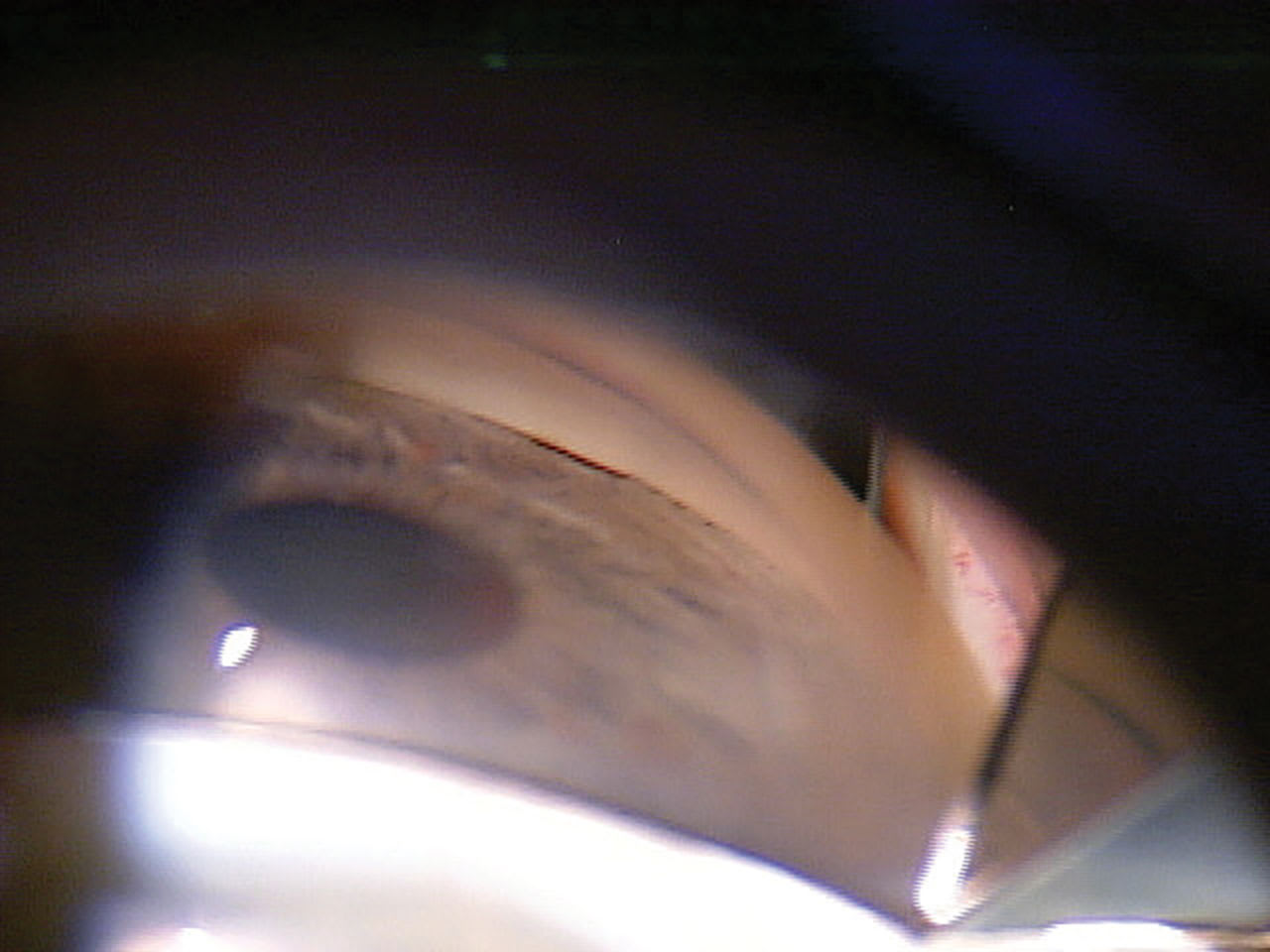 <p><strong>Figure 1.</strong> When gonioscopic examination of a 63-year-old patient with glaucoma revealed a narrowed angle, the patient was referred to a glaucoma surgeon for evaluation.</p>
