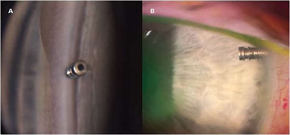 Figure 1. Glaukos Idose sustained-release travoprost device after implantation in the trabecular meshwork (A, B).