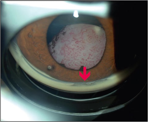 Figure 1. Adenocarcinoma of the ciliary body epithelium interposed between the anterior lens capsule and the iris, causing sector angle closure (arrow). Figure courtesy Paul T. Finger, MD.