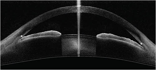 Figure 1. Swept-source optical coherence tomography of a closed angle. The asterisks indicate the location of the scleral spurs, which are identified by an inward protrusion of the sclera, a change in curvature of the inner angle wall, or the junction between the more reflective sclera and the less reflective ciliary muscle. Note the iridocorneal contact anterior to the scleral spur, consistent with angle closure. Image courtesy of Tin Aung, MBBS, FRCS(Ed), PhD