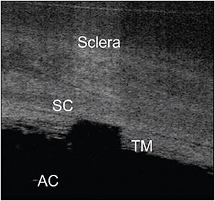 Figure 3. Optical coherence tomography image guidance facilitates precise location of the trabecular meshwork and Schlemm’s canal.