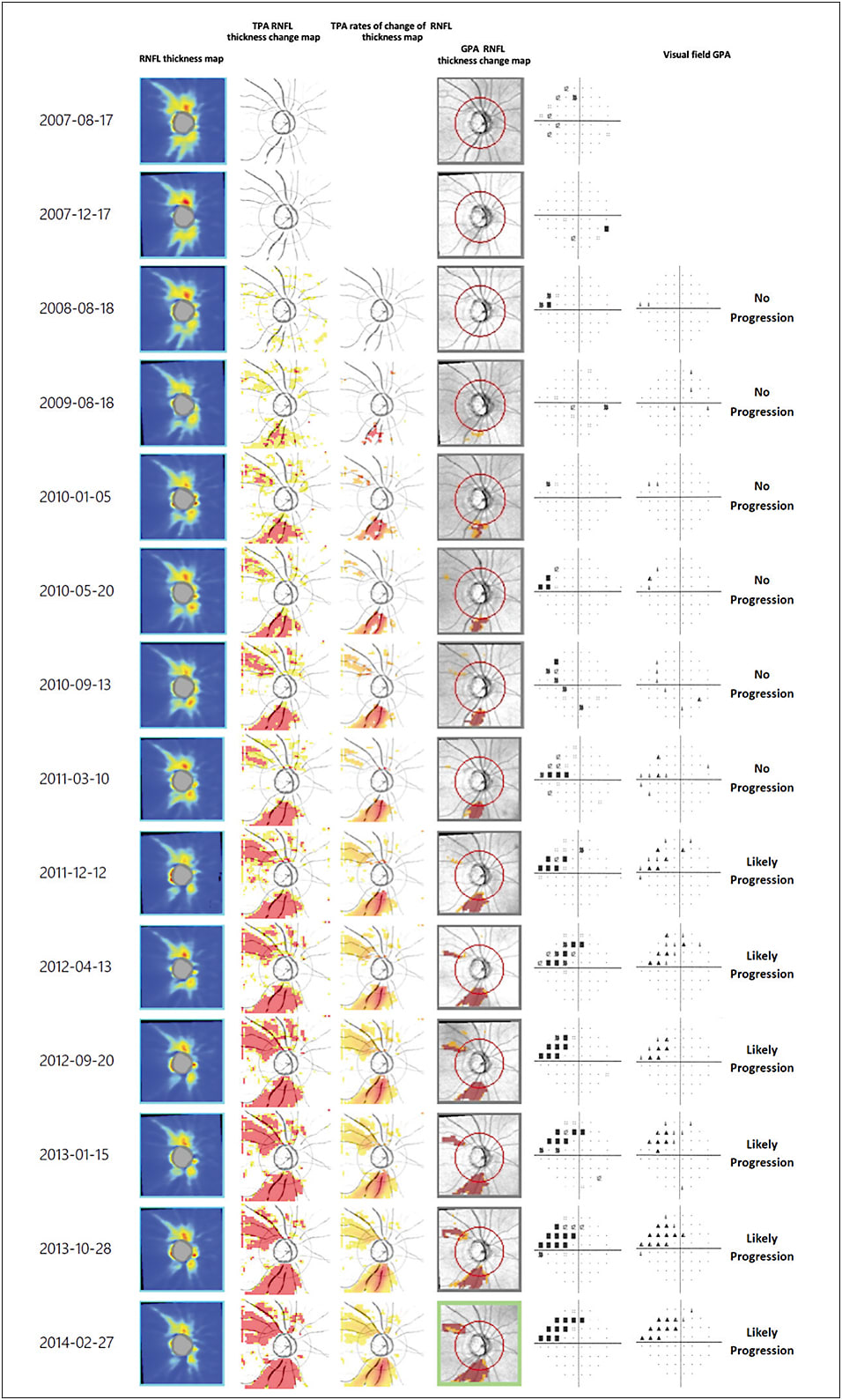 Figure 1. A case example demonstrating the temporal sequence of progressive retinal nerve fiber layer (RNFL) thinning and visual field progression of a 66-year-old patient with primary open-angle glaucoma. Progressive RNFL thinning at the inferotemporal and superotemporal sectors was first detected by TPA on Aug. 18, 2009, and Sept. 13, 2010, respectively; and then by GPA on Jan. 5, 2010, and April 13, 2012, respectively. “Likely” visual field progression was observed on Dec. 12, 2011. The rate of change of RNFL thickness map shows the inferotemporal RNFL declined at a faster rate than the superotemporal RNFL (increasing intensity of red represents increasing rate of RNFL thinning).