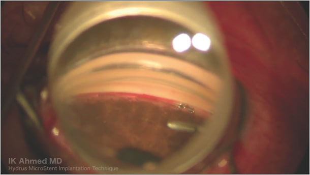 Figure 1. The Hydrus microstent implanted in Schlemm’s canal. Retrieved from https://www.youtube.com/watch?v=qebLSny_nHY. IMAGE COURTESY IQBAL IKE K. AHMED, MD