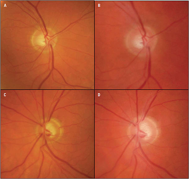 Figure 9. Optic nerve photos of a 78-year-old white male demonstrating subtle progressive cupping over time (OD 2013 [A] and 2019 [B]; OS 2013 [C] and 2019 [D]) especially superiorly and temporally. There is a slight change in vessel curvature in both eyes.