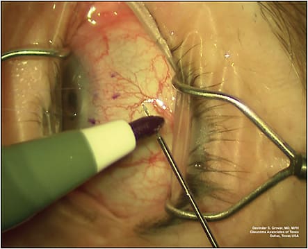 Figure 1. Intraoperative photograph demonstrating the use of a surgical marking pen to mark the tip of the Xen injector.