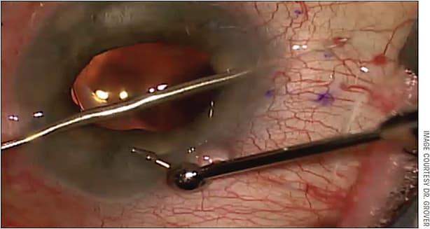 Figure 3. Intraoperative photograph demonstrating the counter traction that is occasionally needed to ensure the needle tip of the injector is in ideal position. Again, note that the injector is exiting the sclera roughly 2 mm posterior to the limbus.