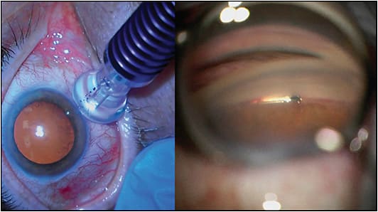 Figure 2. Micropulse combined with Hydrus Microstent (Ivantis).