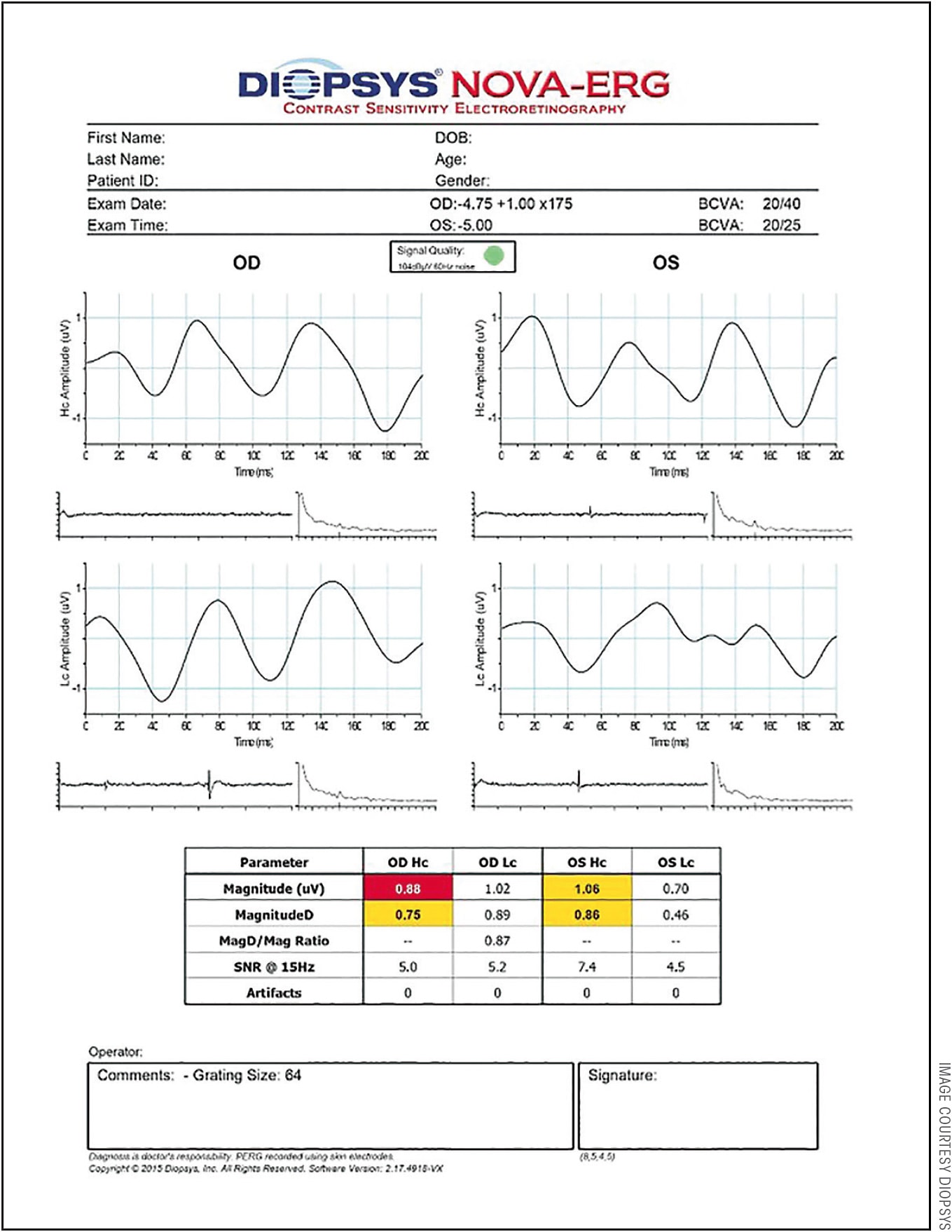 Figure 1. Electroretinography taken before IOP-lowering therapy.