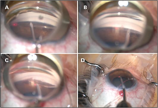 Figure 3. A goniotomy was performed on the nasal trabecular meshwork. Note the dense pigmentation of the angle (A). A catheter was advanced through Schlemm’s canal using microforceps (B). The distal tip emerged through the goniotomy and was grasped (C). The proximal portion was pulled, and a circumferential goniotomy was completed (D).