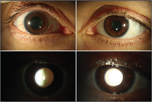 Figure 1. Slit-lamp examination demonstrates a mydriatic right pupil. On retroillumination, transillumination defects were more apparent in the left eye due to the presence of a cataract in the right eye.