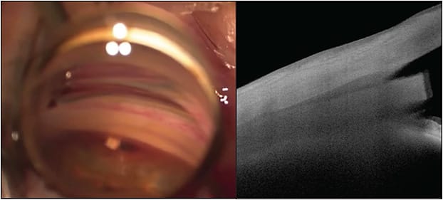 Figure 1. Gonioscopic view showing the AlloFlo implant (Iaktrek) in proper position within the cyclodialysis cleft (A). Image courtesy of Iantrek. Optical coherence tomography imaging of the AlloFlo showing the homologous allograft implant and its isoechoic coherence and bioconformity to the native supraciliary tissues (B).