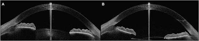 Figure 3. Anterior-segment optical coherence tomography images before endocycloplasty (A) and after endocycloplasty (B). Note differnce between treated nasal angle and untreated temporal angle after lens extraction.