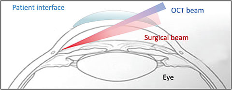 Figure 2. The femtosecond laser image-guided high-precision trabeculotomy (FLigHT) treatment (ViaLase) incorporates a gonioscopic femtosecond laser with integrated optical coherence tomography.