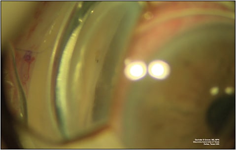 Figure 4. Intraoperative gonioscopic photograph demonstrating the ideal positioning of the Xen implant, anterior to the trabecular meshwork. One can appreciate a small air bubble at the tip of the implant.