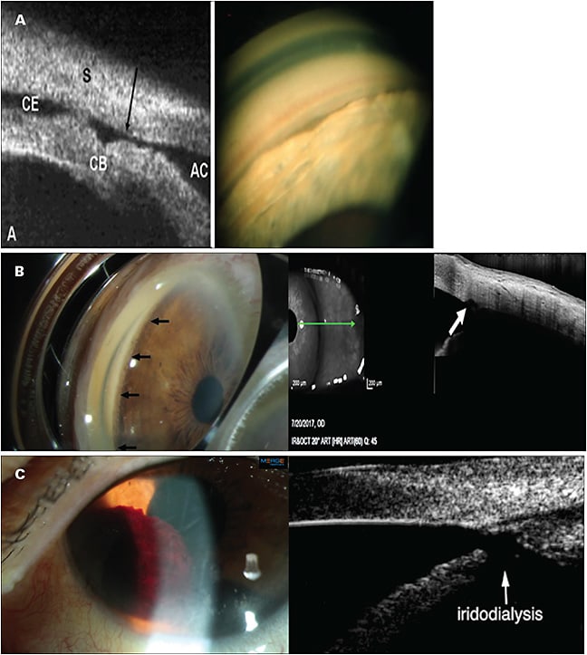 Figure 4. Cyclodialysis cleft not seen but suspect with severe hypotony post Trabectome (NeoMedix) procedure (A). Kahook Dual Blade (New World Medical) 1 year post procedure, patent cleft visualized on gonioscopy and AS-OCT (B). Hyphema and iridodialysis post Trabectome (C). CE, choroidal effusion; CB, ciliary body; S, sclera; AC, anterior chamber.