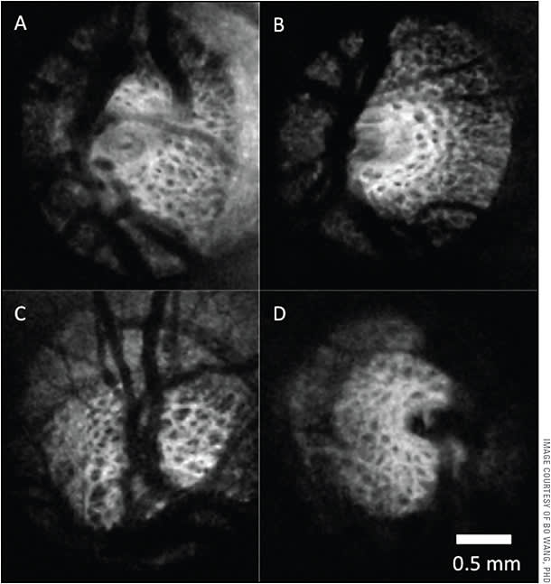 Figure 1. Lamina cribrosa C-mode of healthy (A-B) and glaucomatous (C-D) eyes. SS-OCT offers enhanced penetration into the optic nerve, providing the ability to assess the lamina crirbosa microstructure.