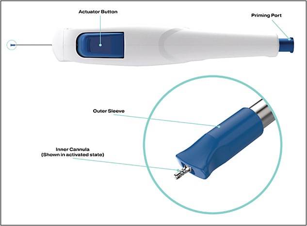 Figure 2. Two side ports in Streamline’s inner cannula facilitate delivery of a viscoelastic agent into Schlemm’s canal after goniotomy with the device.