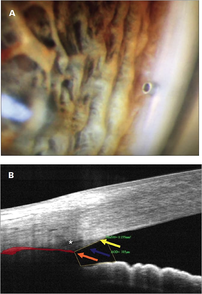 Figure 3. Placement of iStent (Glaukos) viewed with goniolens (A). Anterior angle viewed with AS-OCT (B) (yellow: Schawlbe line, blue: trabecular meshwork, orange: scleral spur, red: supraciliary space).