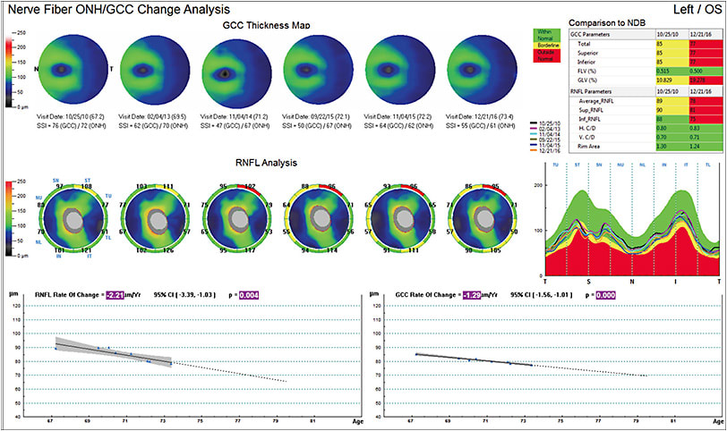 Figure 2. Trend analysis OS showed an RNFL rate of change of -2.21 µm/yr and a GCC rate of change of -1.29 µm/yr.