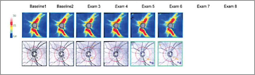 Figure 2. Visual field testing revealed a localized paracentral scotoma.