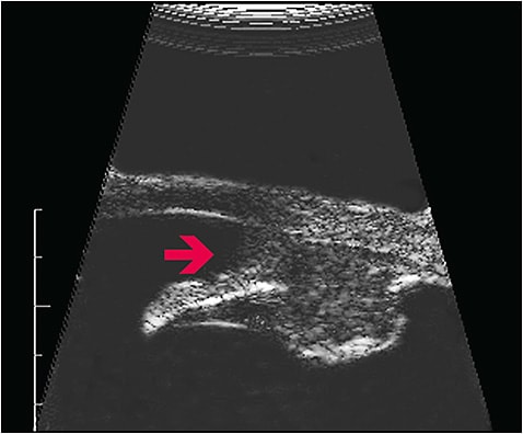 Figure 3. High-frequency ultrasound biomicroscopy imaging reveals that the ciliary body tumor has growth through the iris root, as evidenced by blunting of the natural iridocorneal angle (arrow). Figure courtesy Paul T. Finger, MD.