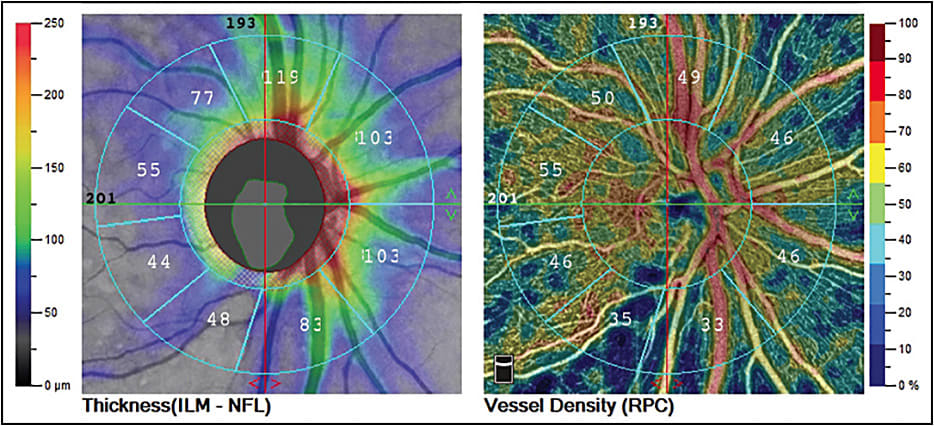 AngioVue AngioAnalytics image showing disc retinal nerve fiber layer thickness. Image courtesy Optovue.