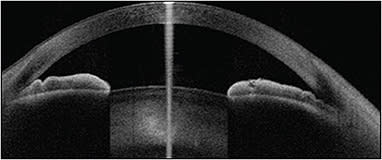 Figure 1. Anterior-segment optical coherence tomography image of an eye with mild pupillary block.