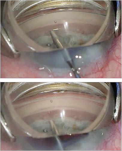 Top: Intraoperative photo of an iStent prior to insertion. The visible portion of the device will be placed within Schlemm’s canal and will allow the aqueous to bypass the trabecular meshwork; Bottom: Intraoperative photo of an iStent after insertion. Note the “snorkel” that is pointing back toward the inserter, which is the opening through which the aqueous will flow. The remainder of the device is seated within Schlemm’s canal.