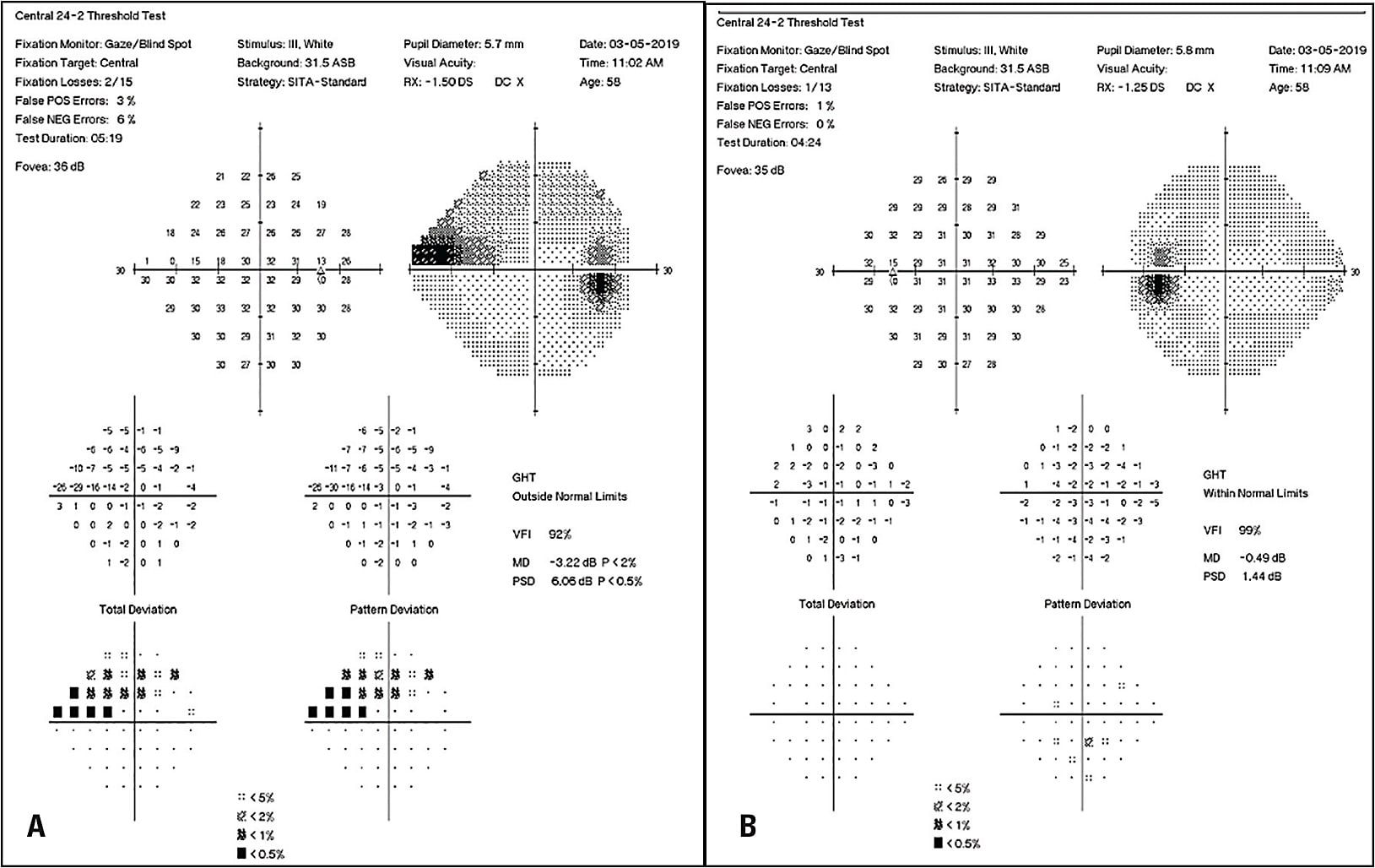 Figure 2. Visual field showing a nasal step on the right (A) and a relatively normal reading on the left (B) in a 59-year-old Asian male.